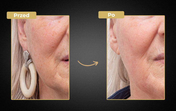 Mezoterapia + laser tulowy 60% taniej! Efekt GLOW i BABY FACE w jeden dzień - obrazek 2