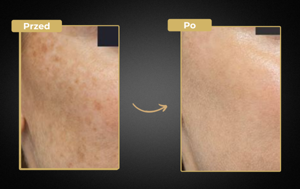 Mezoterapia + laser tulowy 60% taniej! Efekt GLOW i BABY FACE w jeden dzień - obrazek 3