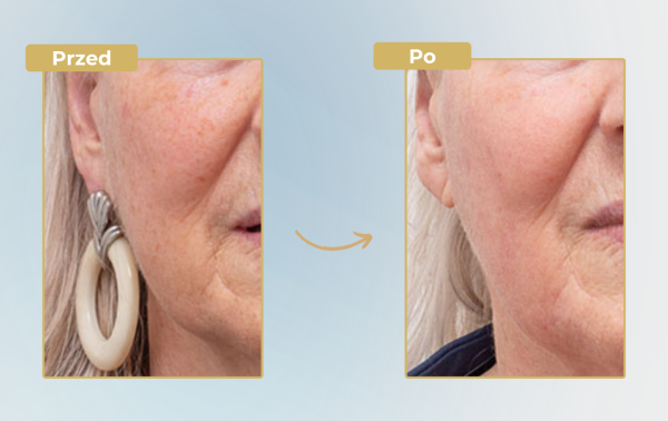 Stymulatory tkankowe + laser tulowy – 58% taniej - obrazek 3
