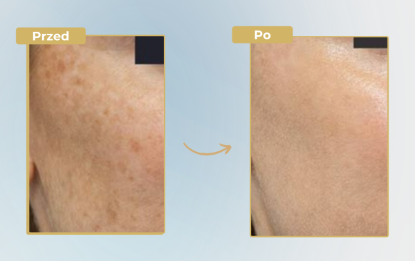 Stymulatory tkankowe + laser tulowy – 58% taniej - obrazek 2