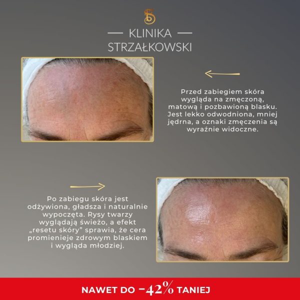 Reset skóry po lecie - 3 zabiegi w trakcie 1 wizyty do 42% taniej - obrazek 2